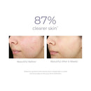 Derma E Acne Rebalancing Cream - 56g - Skin Care